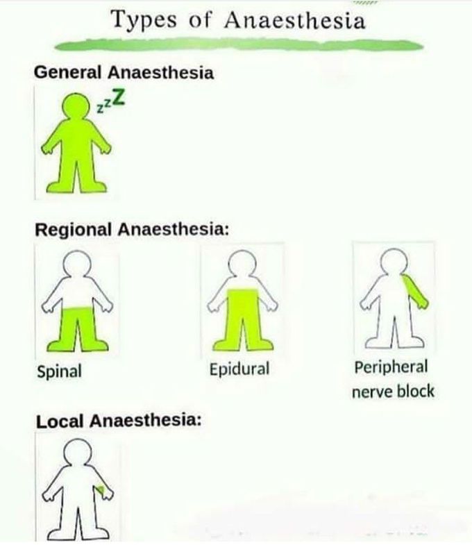 Types of anesthesia