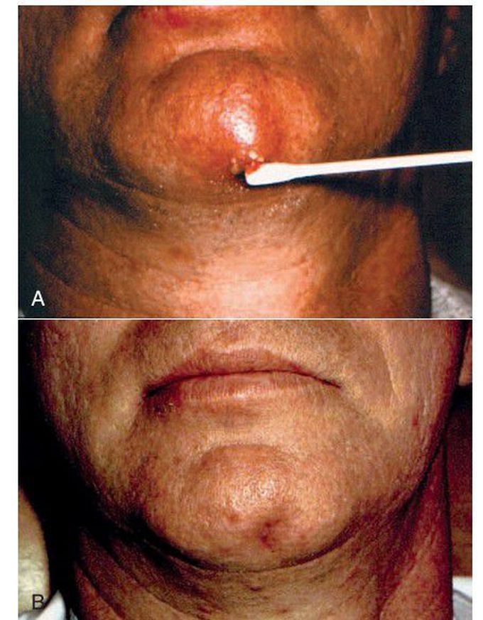 Extraoral sinus tract