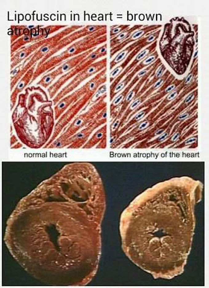 Brown atrophy of the heart in gross and microscopic examinations characterized by decrease size and brown coloration hope this is helpful