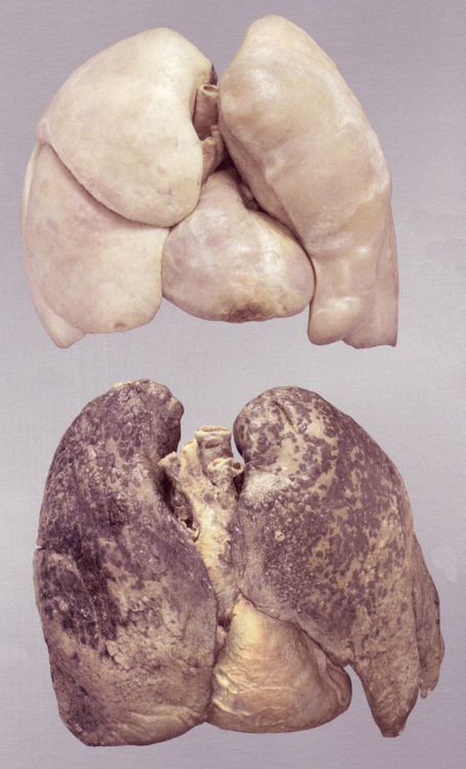 Healthy vs smoker's lungs