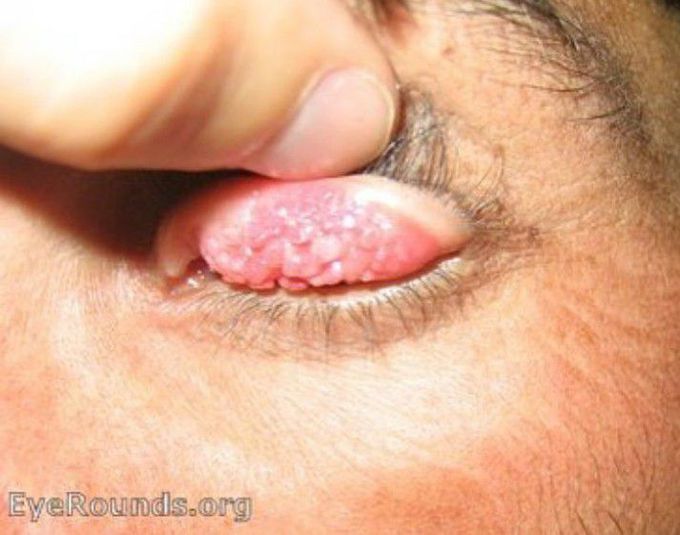 Name the disease