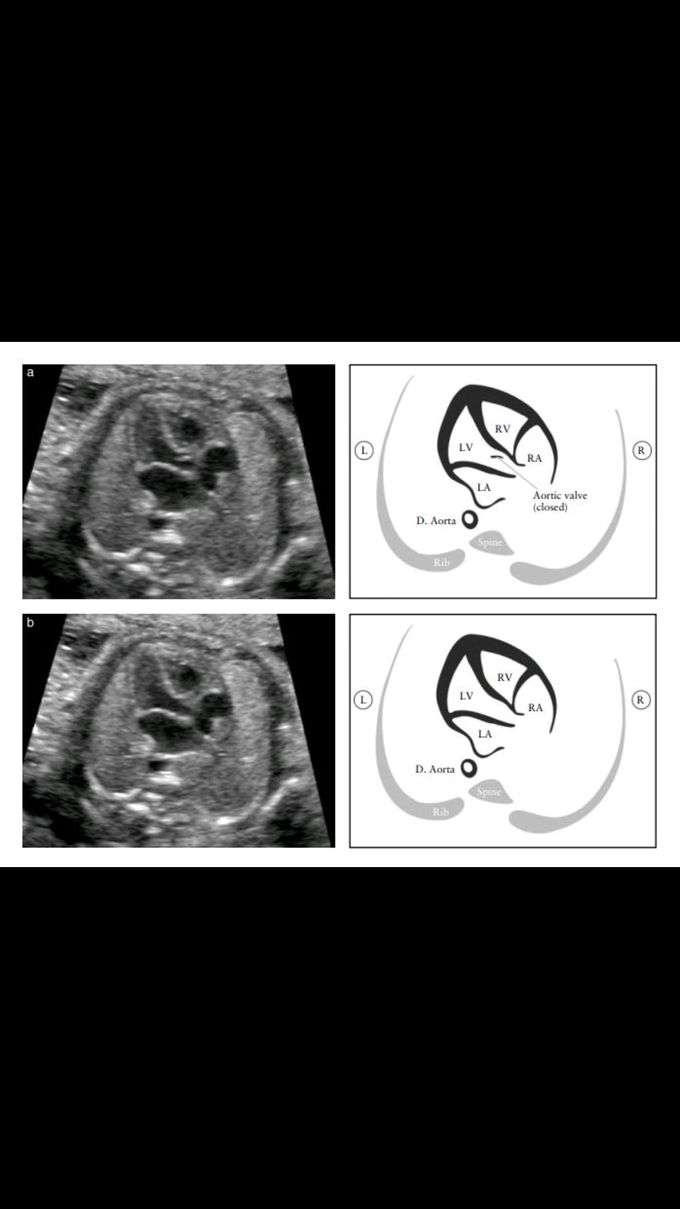 Fetal Heart