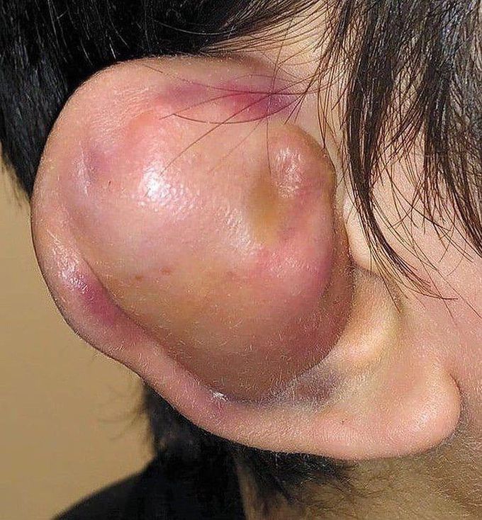 Cauliflower Ear (Auricular hematoma)
