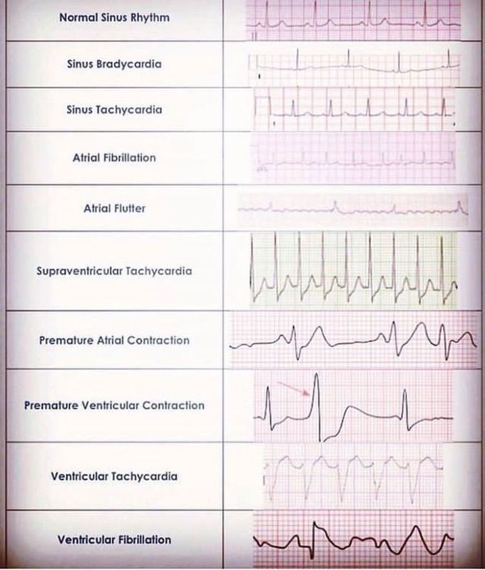 ekg-reading-medizzy