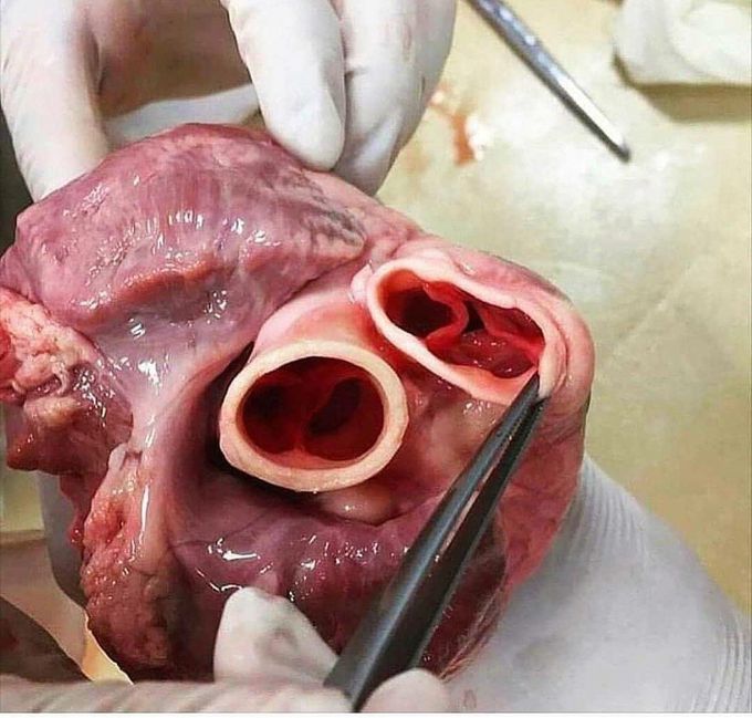 Heart valves
