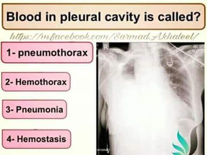 Blood in pleural cavity is called?
