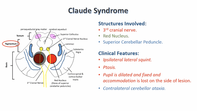 These are the clinical features of Claude syndrome