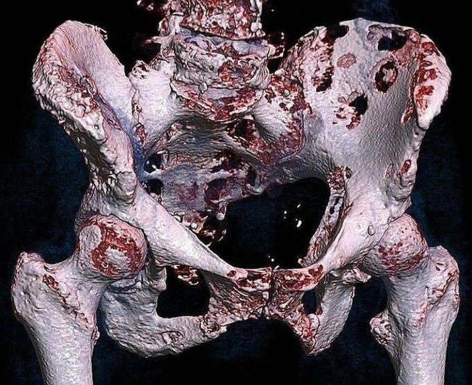 Bone Metastasis