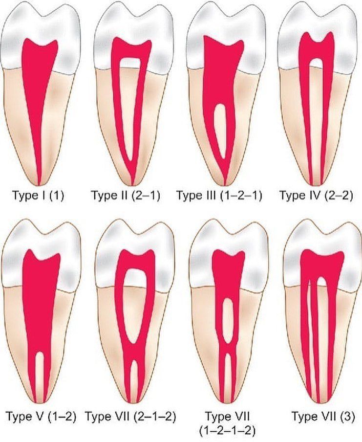 Vertucci's is classification of root canal morphology