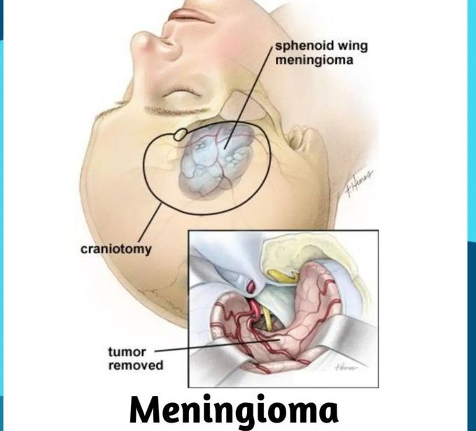 Meningioma