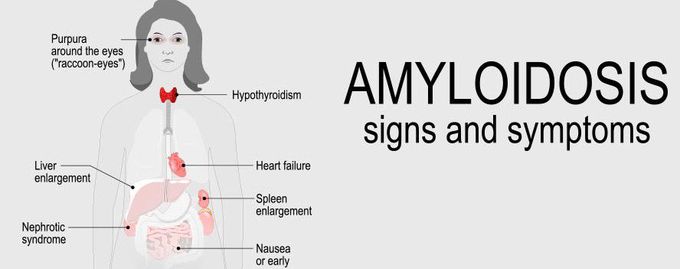 Symptoms of Amyloidosis