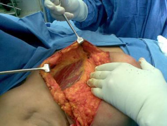 Simple Mastectomy