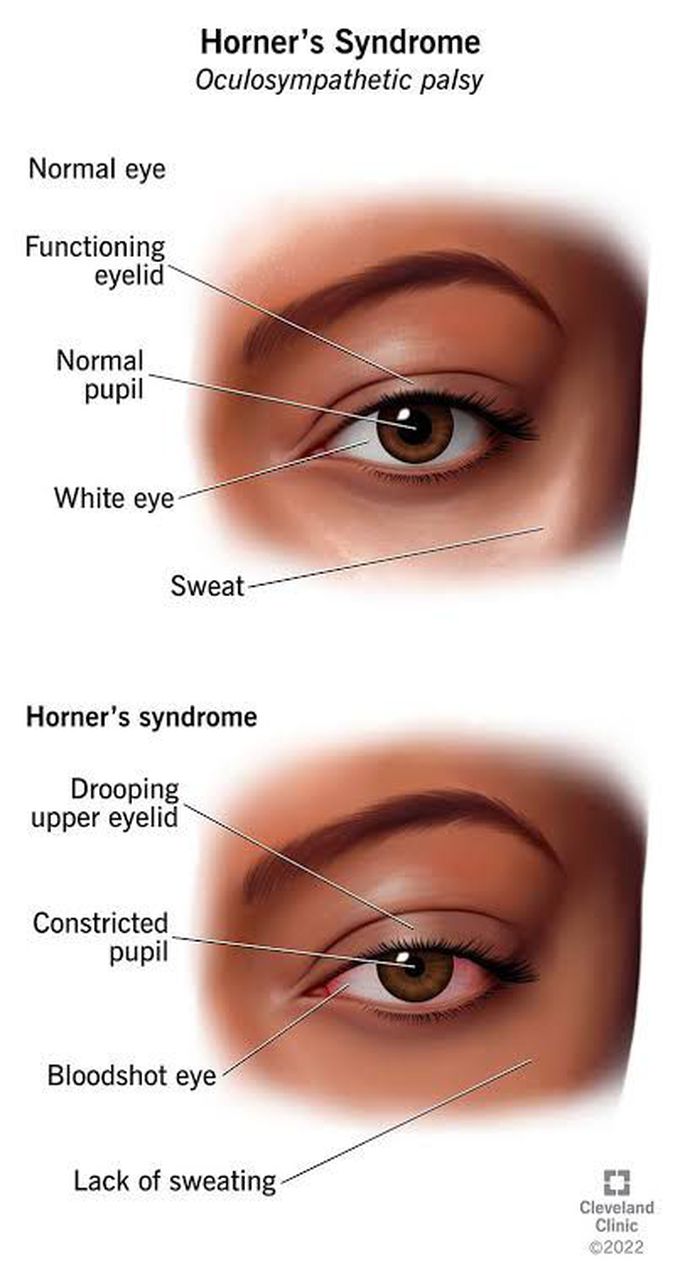 Symptoms of horner syndrome
