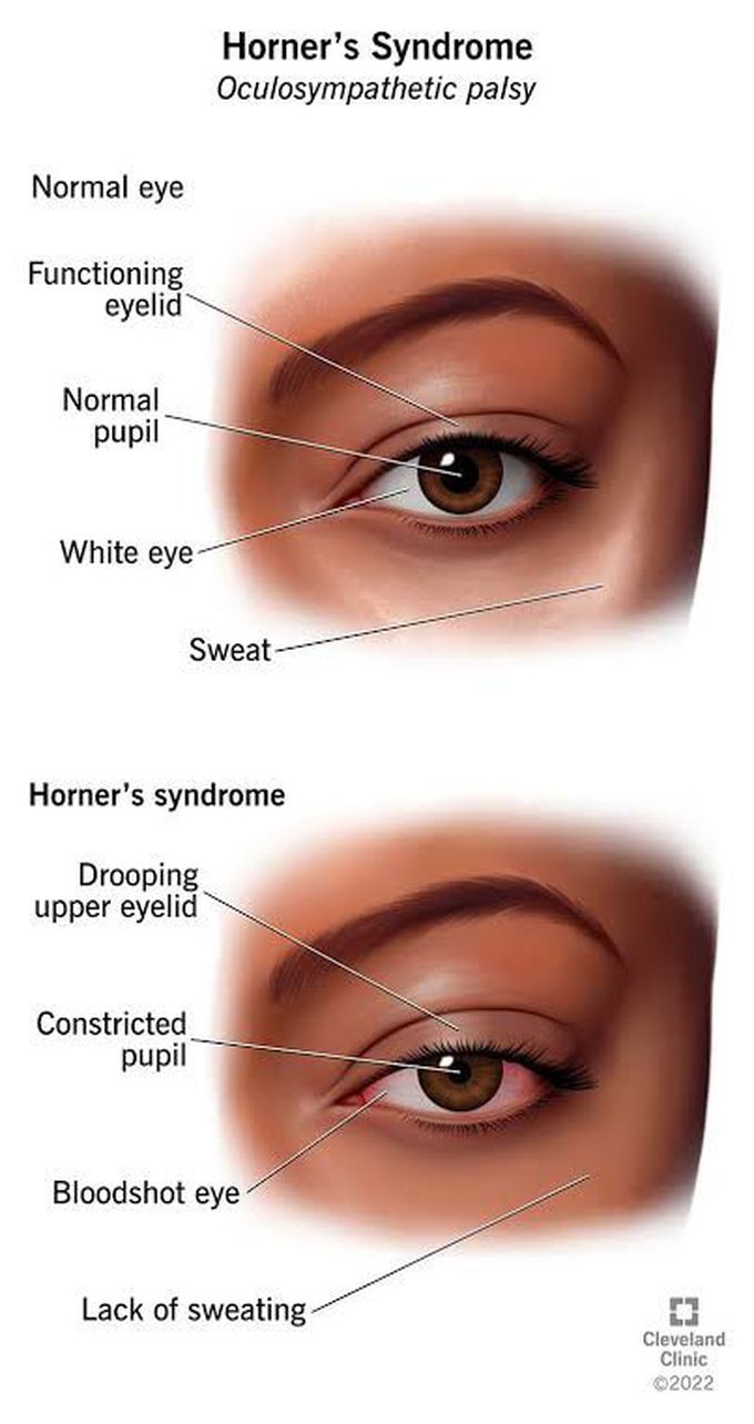 Symptoms Of Horner Syndrome Medizzy 9921