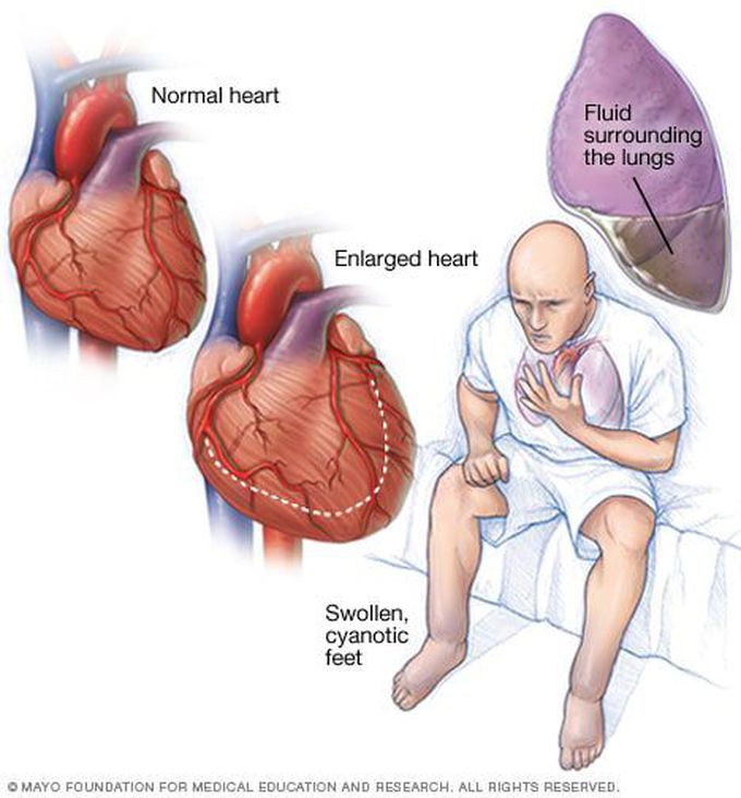 High Output Cardiac Failure