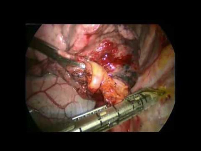VATS Resection of Pulmonary Sequestration