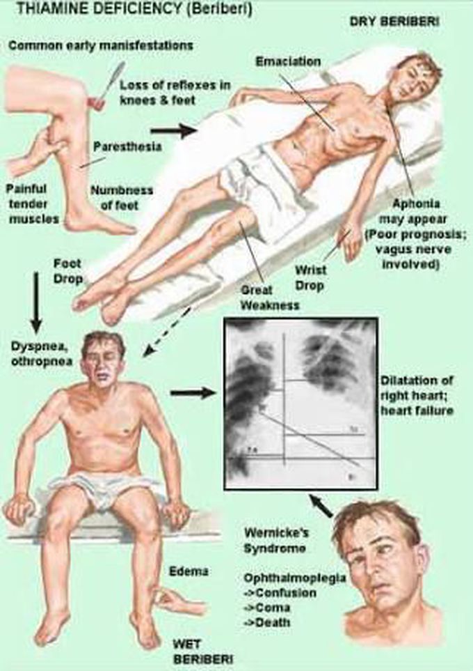 thiamine deficiency