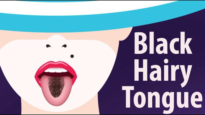 Black Hairy Tongue | Causes and Treatment