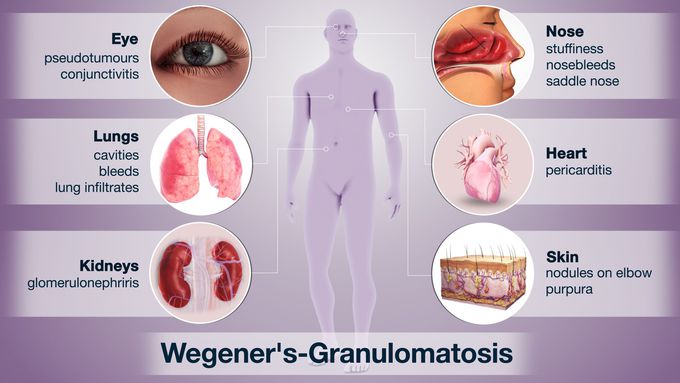 Granulomatosis treatment