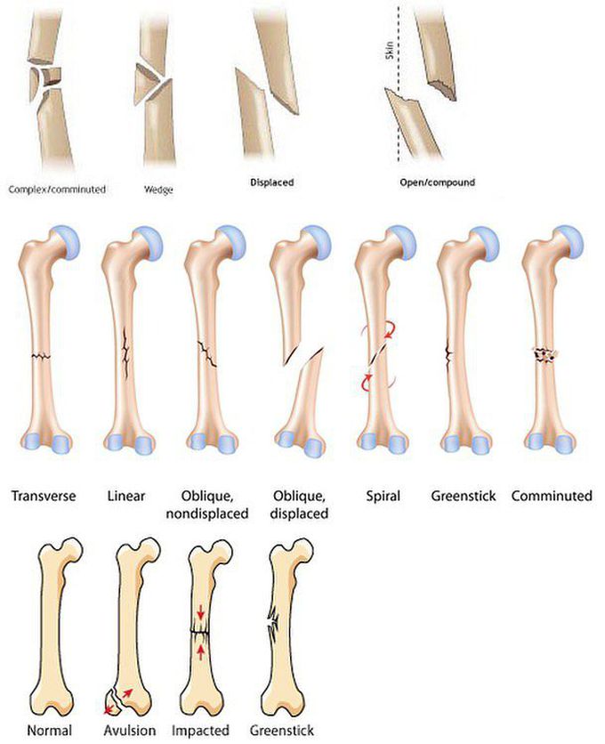 Types of fracture