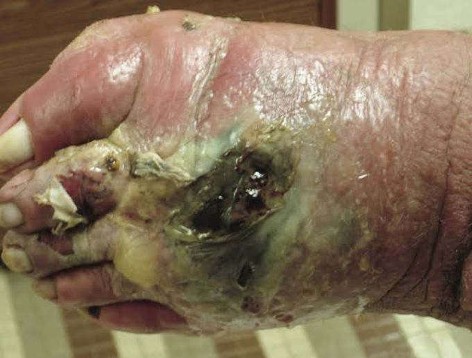 Symptoms of Gas gangrene