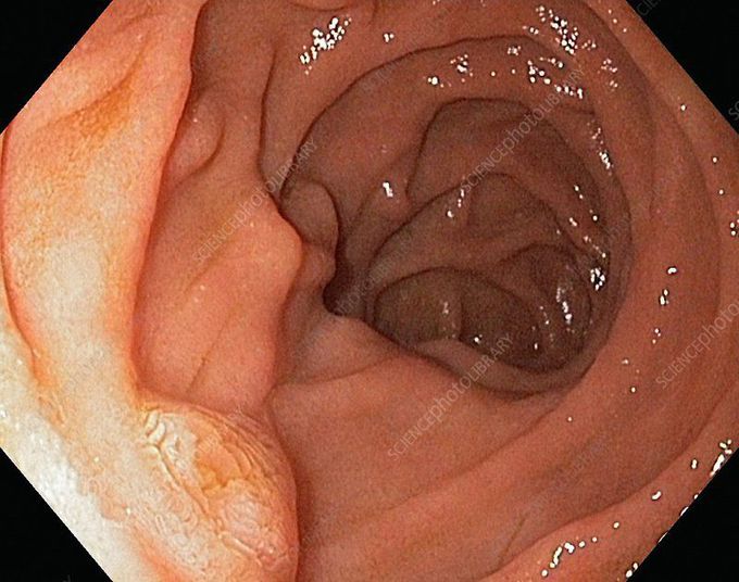 Endoscopic View of Major Duodenal Papilla