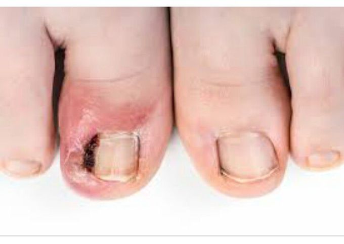 Unguis Incarnates (Ingrown toenails)