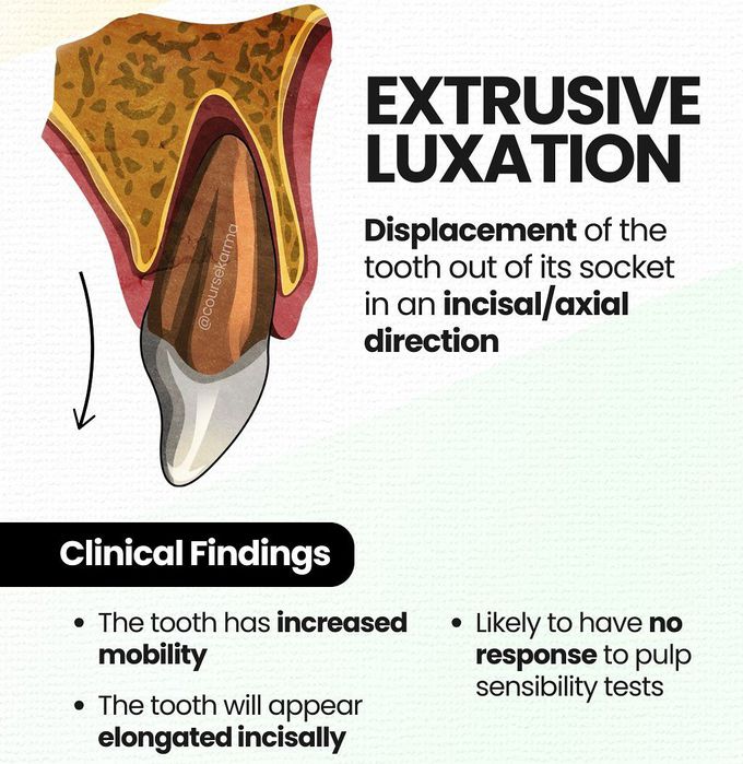 Extrusive Luxation