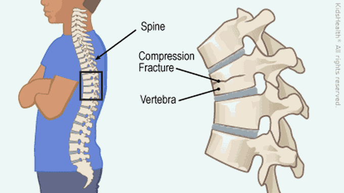 Compression fracture