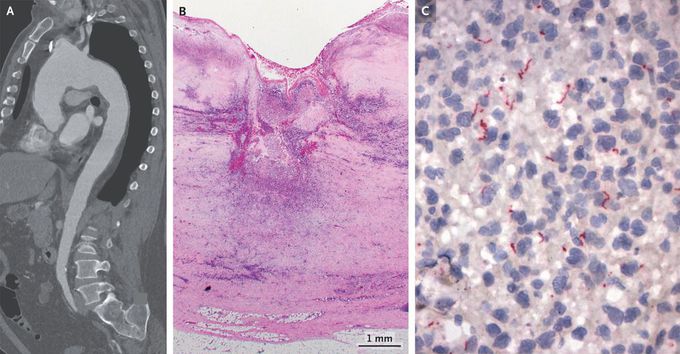 Syphilitic Aortitis