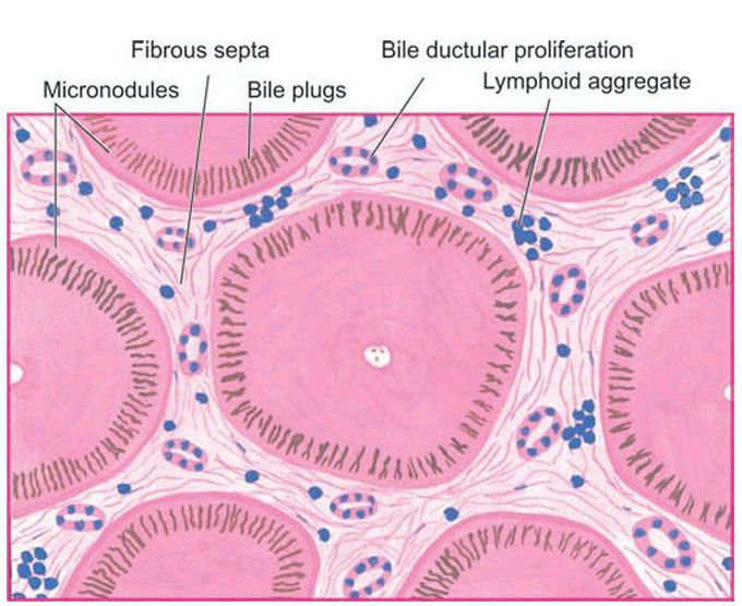 Primary biliary cirrhosis