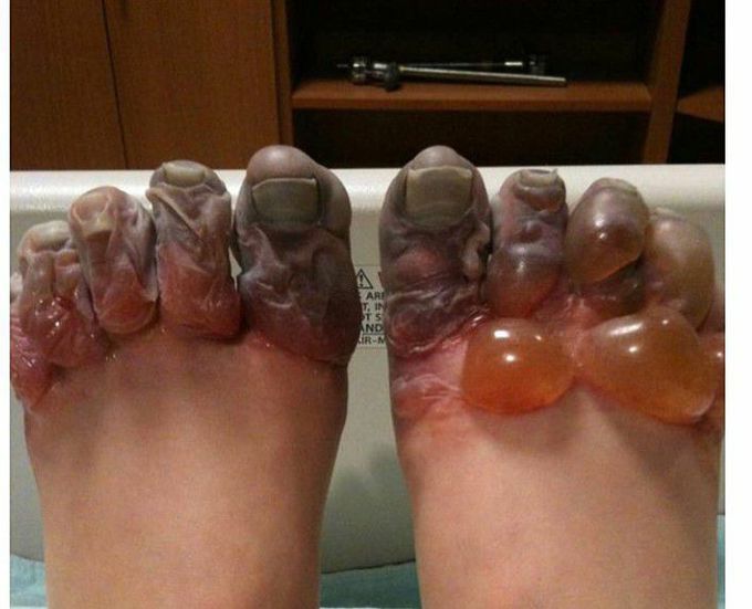 A Case of Frostbite 