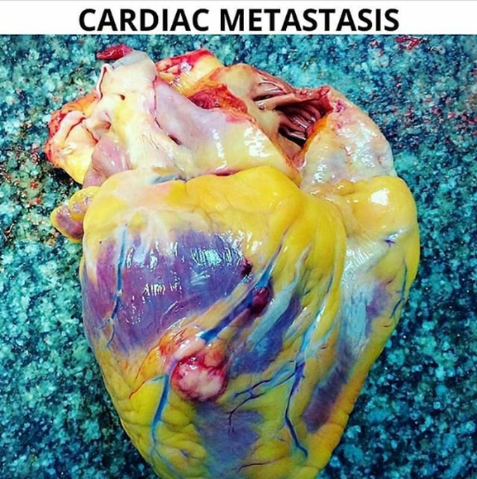 Cardıac