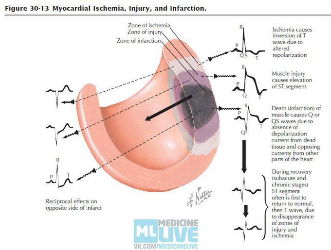 Myocardial ischemia