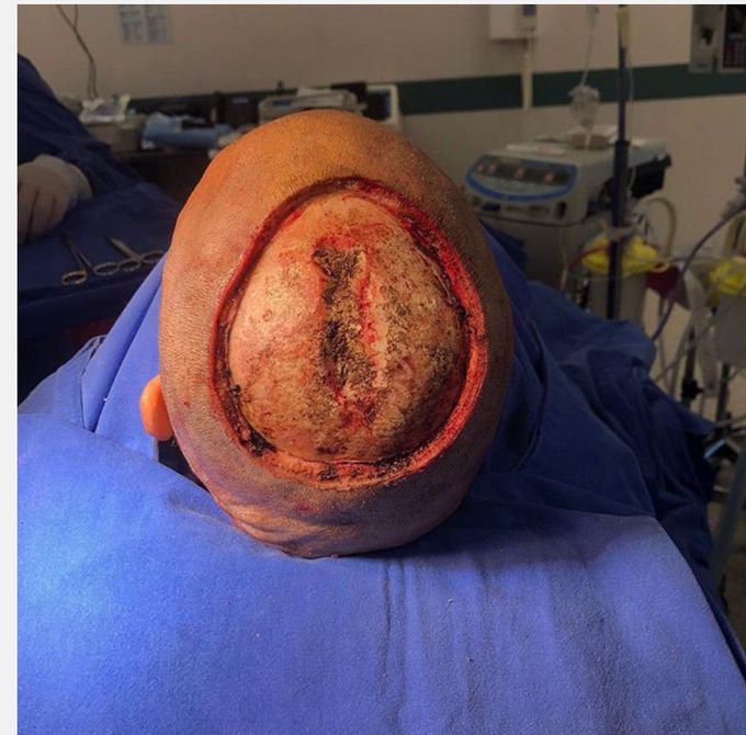 Squamous cell carcinoma