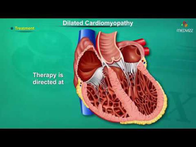 All about Dilated Cardiomyopathy