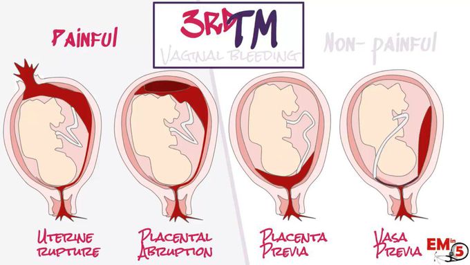 Vaginal Bleeding