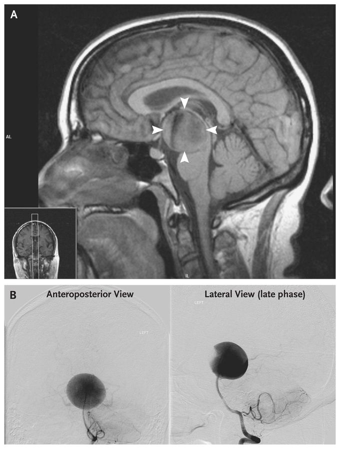 Giant Basilar-Artery Aneurysm