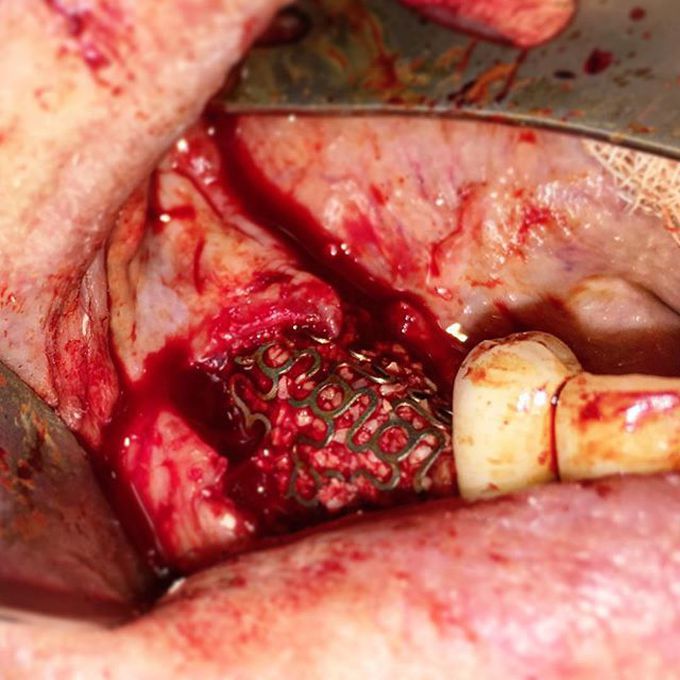 Using titanium mesh for alveolar ridge augmentation