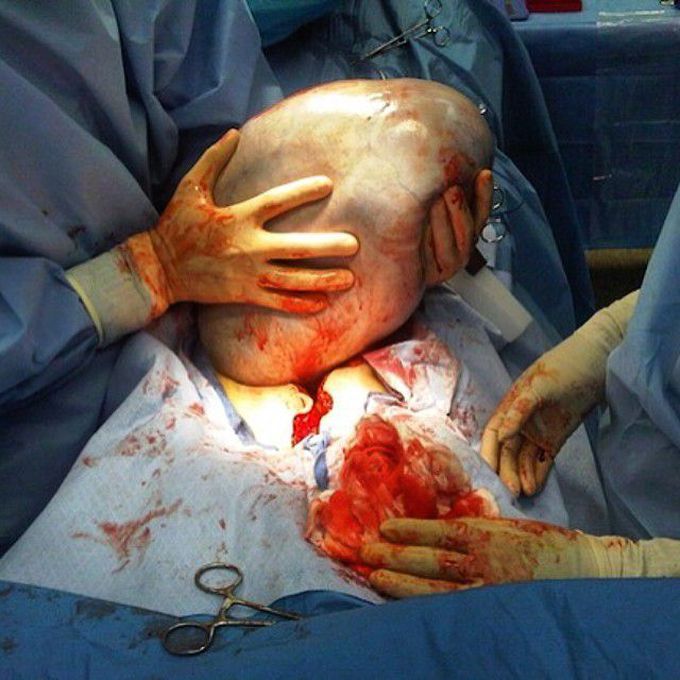 Mucus-filled ovarian cyst