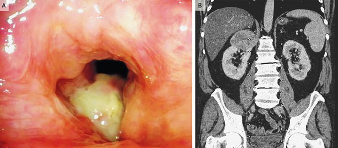 Vocal Cord Metastasis