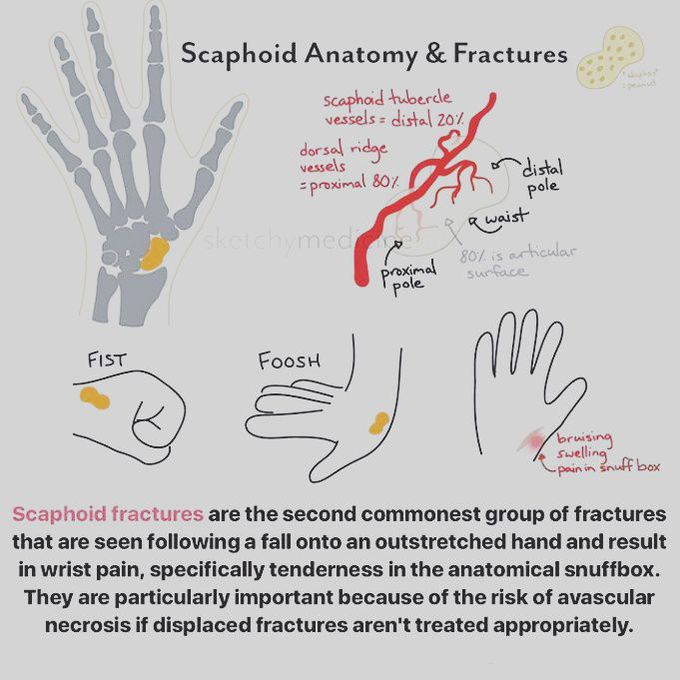 Fracture