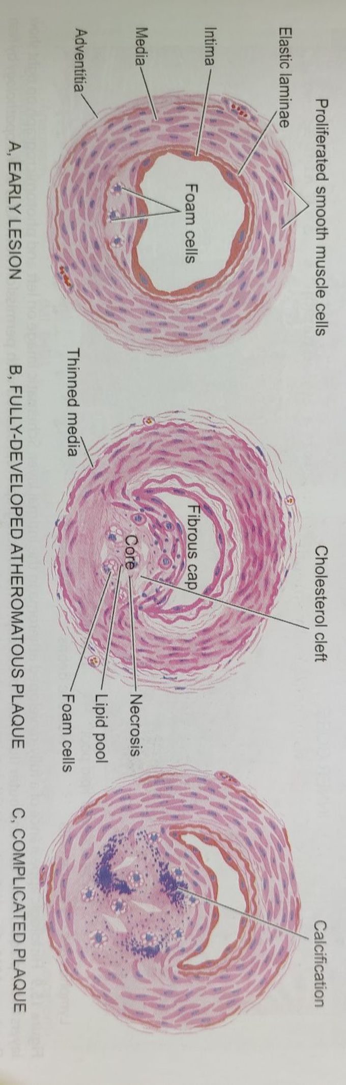 Atherosclerosis