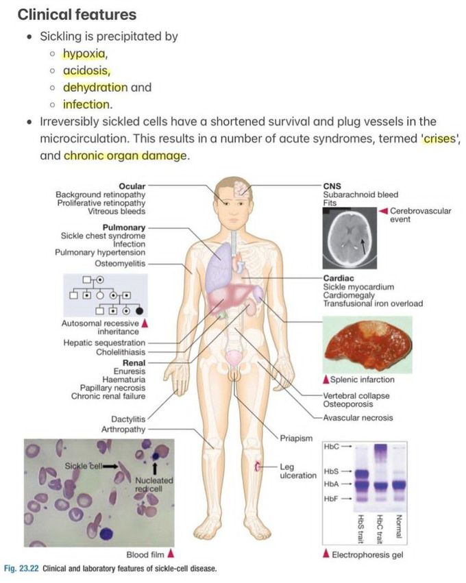 Sickle Cell Disease V