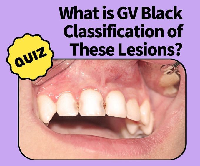 Identify the GV Black Classification