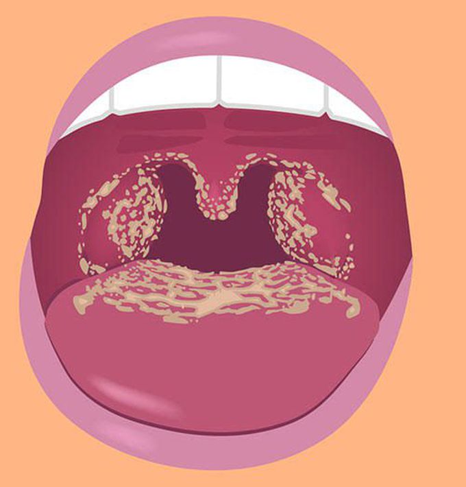 Treatment of candidiasis