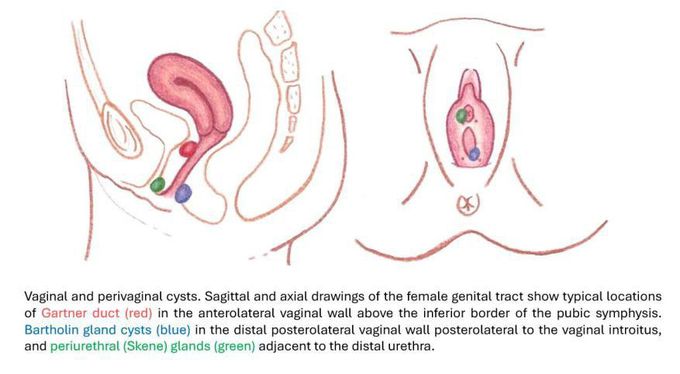 Gartner's Duct Cyst