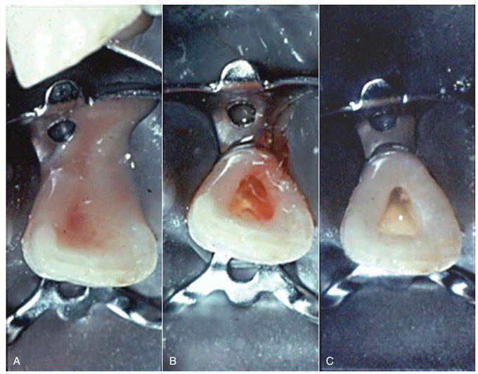 Drainage from tooth