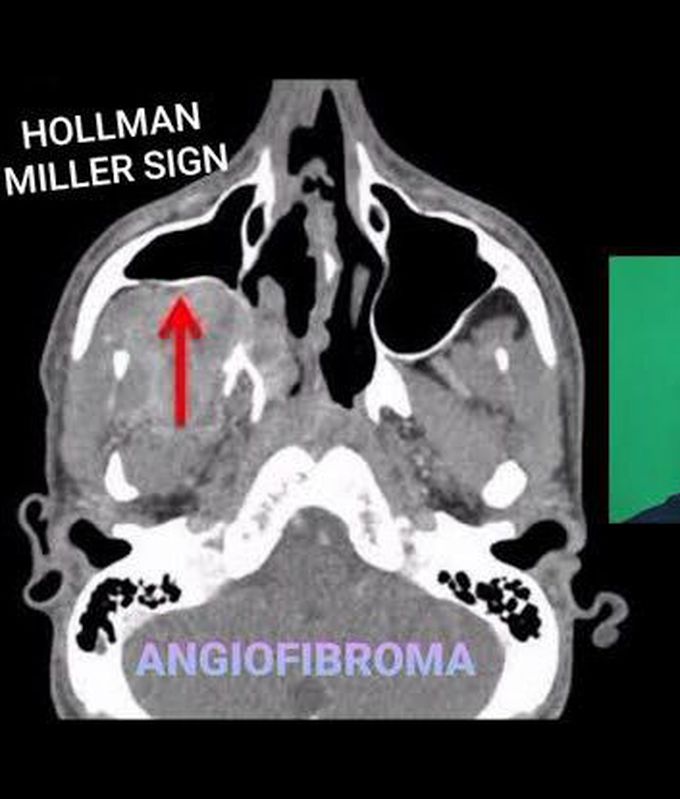 Angio fibroma