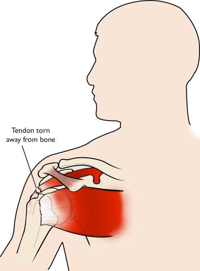 Rotator cuff dysfunction